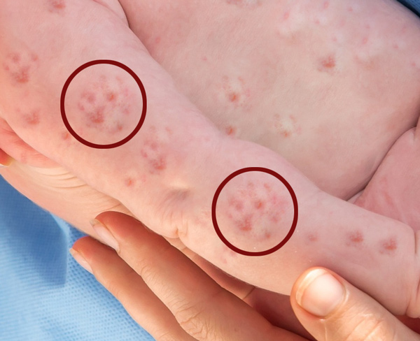 Baby-with-Measles-Repeating-Pattern-Close-Up-1-600.jpg